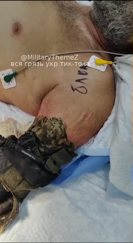 Ukrainian Soldier Suffered a Horrifying Wound