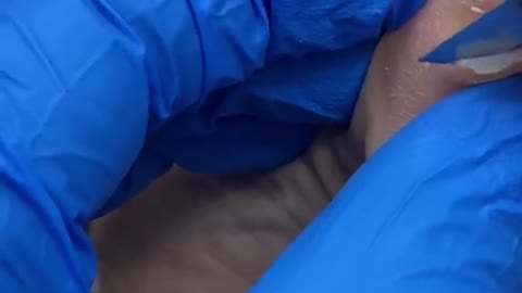 Painful corn removal on little toe by Australian podiatrist