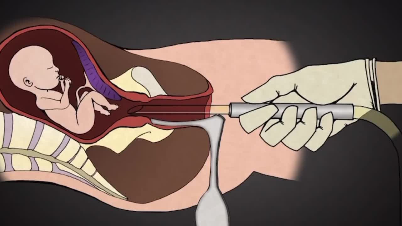 Abortion - Scotty Films