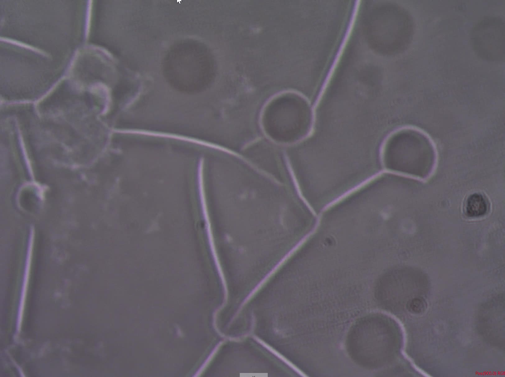 Whats Inside The Blood Clots of CV-19 VAXXXed? What is Causing Blood to Clot?