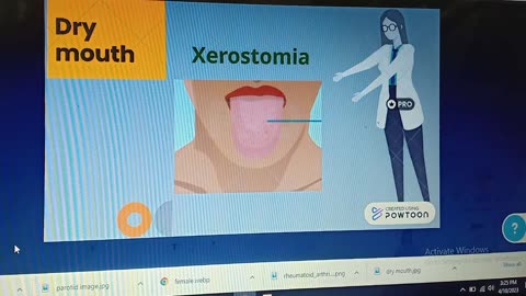 What is Sjogren's syndrome?