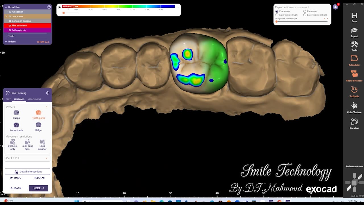 #design #naildesign #dental #dentaldesign #exocadexpert