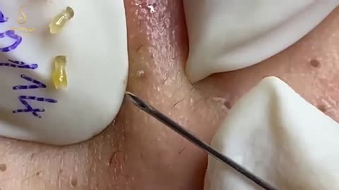 Blackhead remove