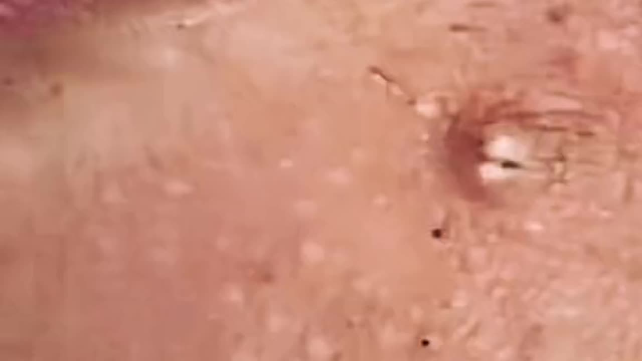 Blackhead removal