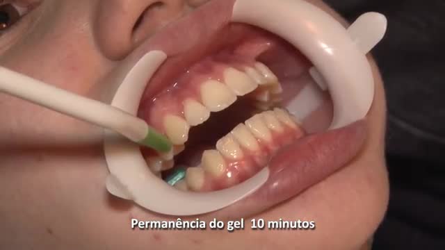 Clareamento dental em consultório com Whiteness HP Blue (Passo a Passo)