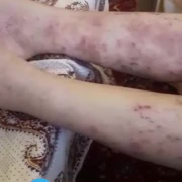 AstraZeneca vaccine reaction