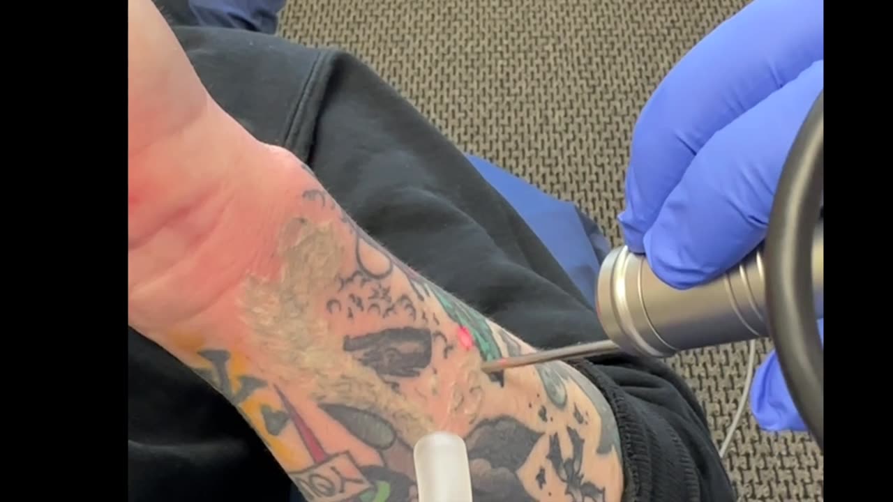 Precision Tattoo Removal