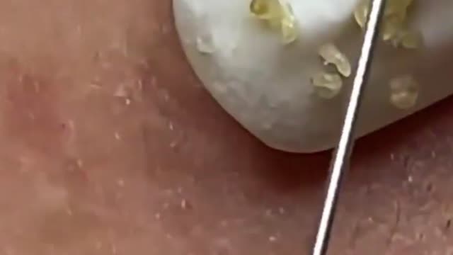 Giants Deep Blackheads, Whiteheads, Big Pimples, Hidden Acne Removal - Best Popping Videos 000007