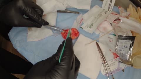 Cutting out a Mozarella Like Cyst in a Back