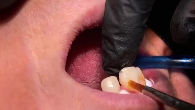 Scaling and polishing of teeth