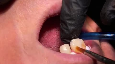 Scaling and polishing of teeth