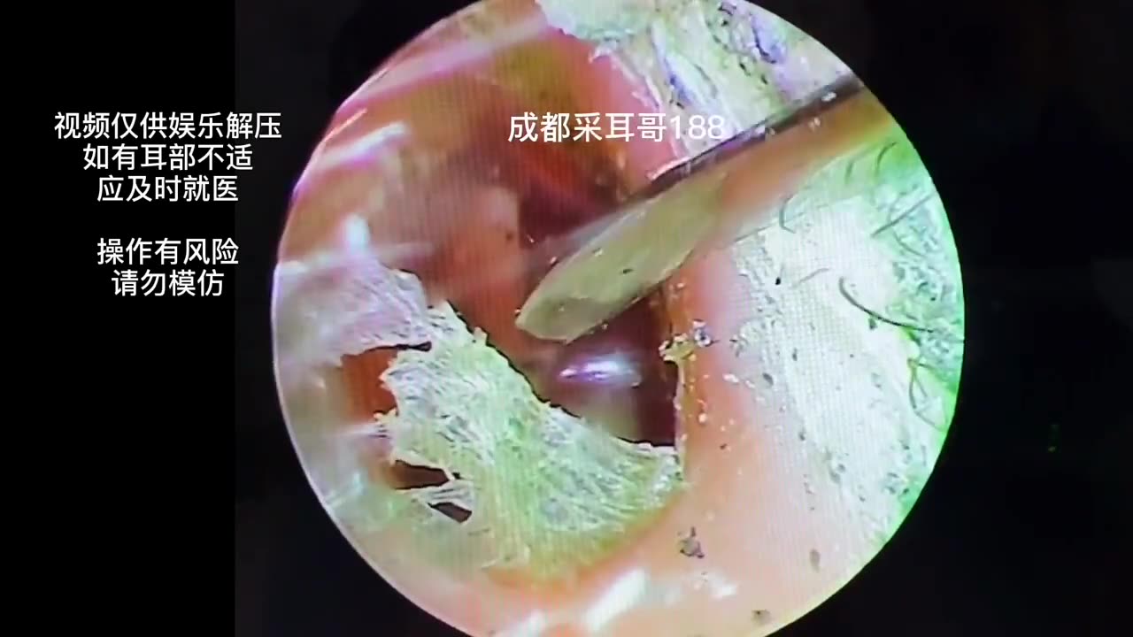 gigantic ear wax removal #23