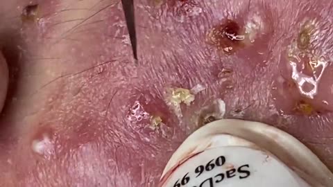 Satisfying Blackheads Cystic Acne Whiteheads Extraction | Dr. Pimple Popper 102