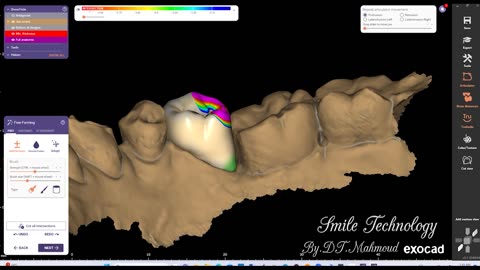 #design #naildesign #dental #dentaldesign #exocadexpert