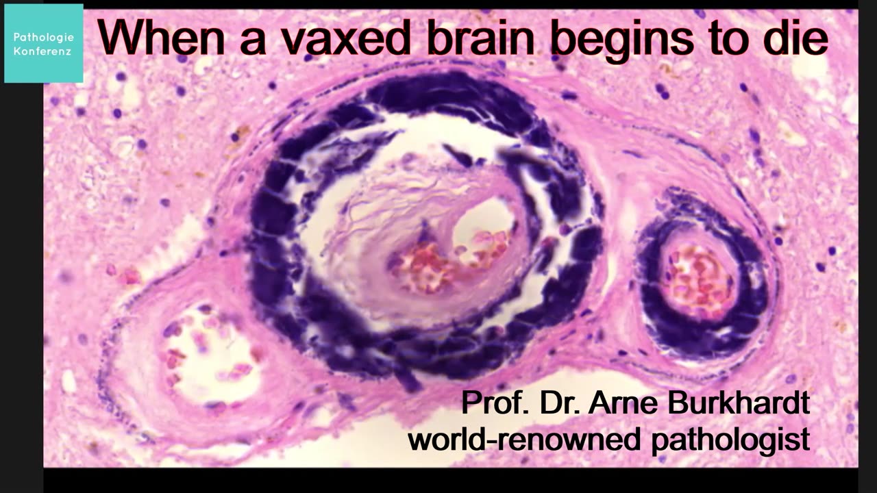 One minute of Truth: When a spiked "vaccinated" brain begins to die