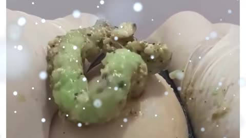 Blackheads Removal