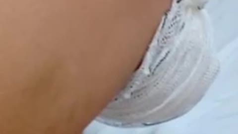 After DEATH VAX woman suffers BLOOD CLOT & LEG AMPUTATION