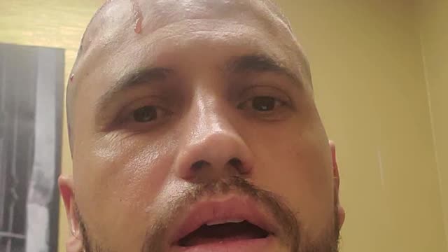 Transplante de cabelo em New Jersey