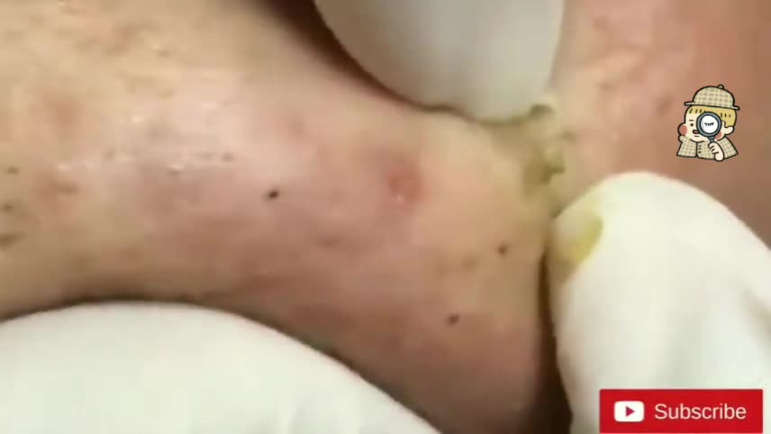 Blackheads Satisfying Removal 🧏✔️✔️