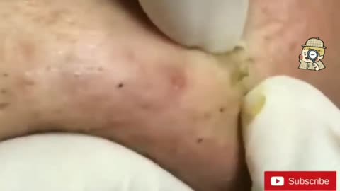 Blackheads Satisfying Removal 🧏✔️✔️