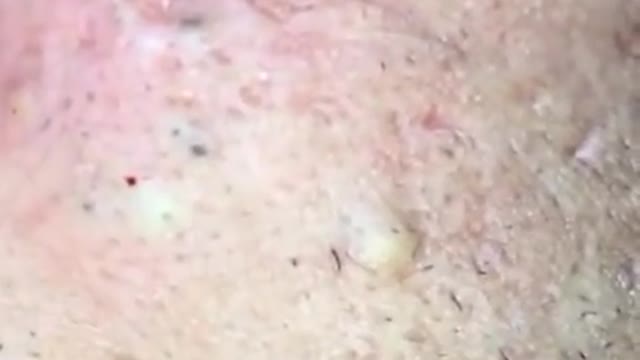 How to remove blackheads from nose, pop pimples, acne treatment #77 #shorts