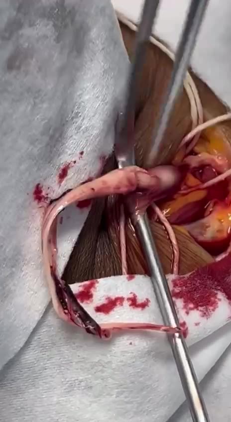 “臨床真實實證”_手術中，在受害者身上拉出的“白色血栓”！魷魚絲般，也像橡皮筋！大、長，具彈性！不似一般血栓，是無法化開的實體！