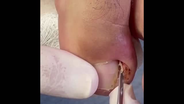 Very Painful Ingrown Toenail Removal