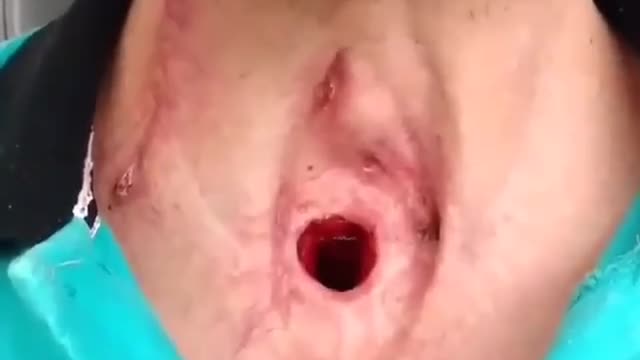 Hole in the Throat!!