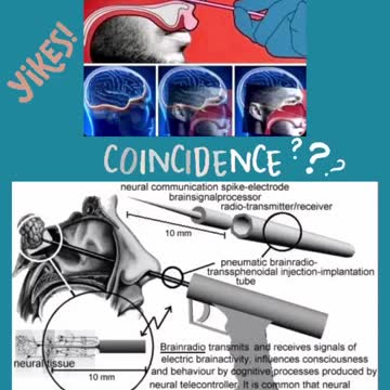 BRAIN RADIO IMPLANT RESEMBLES THE PCR SWAB TEST