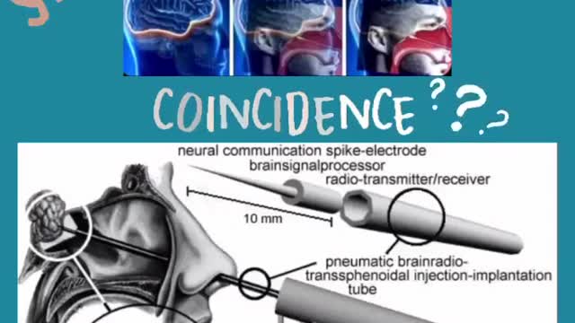 BRAIN RADIO IMPLANT RESEMBLES THE PCR SWAB TEST