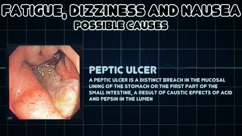 Fatigue, Dizziness and Nausea (Medical Symptom)