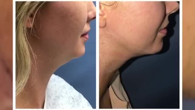 Dr Thomas Barnes AMAZING NECK LIPO RESULTS!