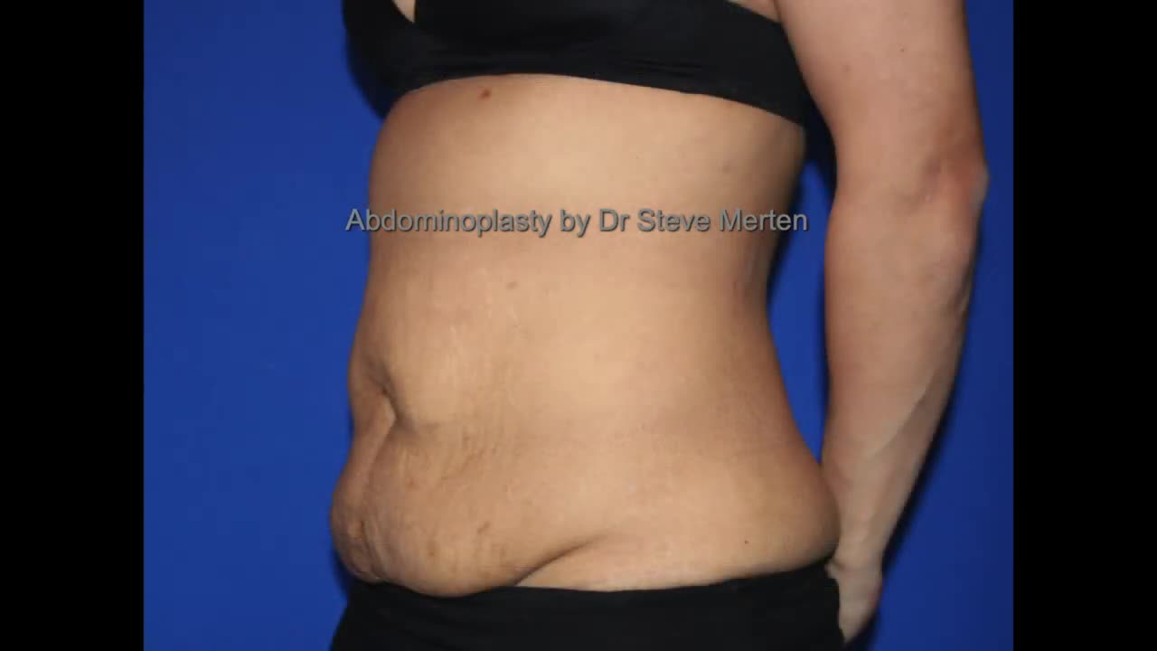 Tummy tuck Before and After Morph Video /shtty