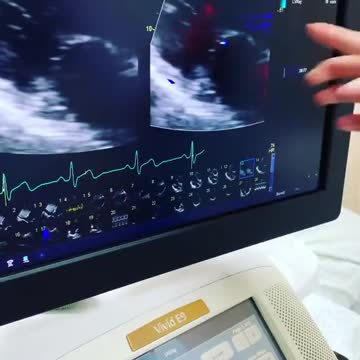 The DEATH VAX World’s top static breath-hold has been diagnosed with myocarditis and pericarditis
