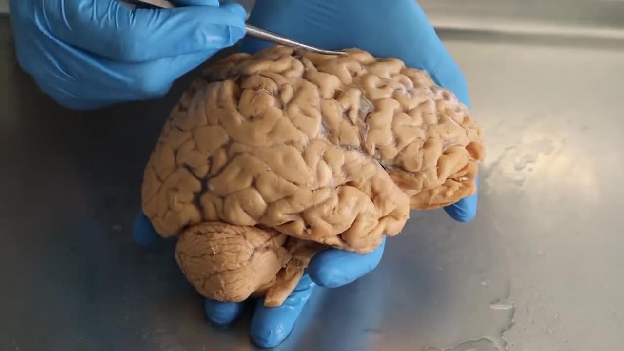 What Are Migraines
