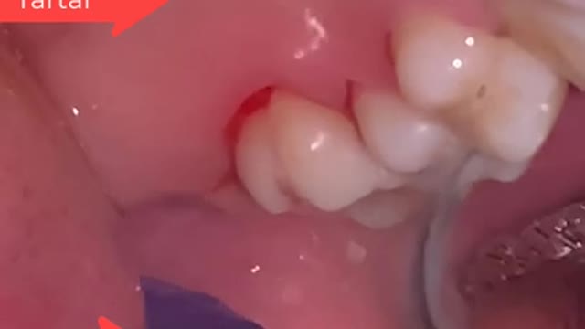 Tartar Dentist 2021 | Satisfying Dental-work