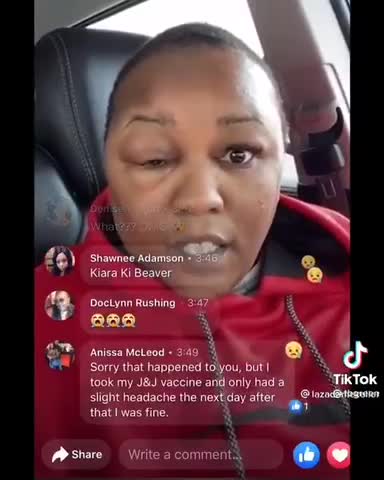 Lady Got a Big Ass Head From the J&J Vaccine