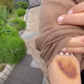 Are Keys Sticking to Vaccination Sites Now? 😳