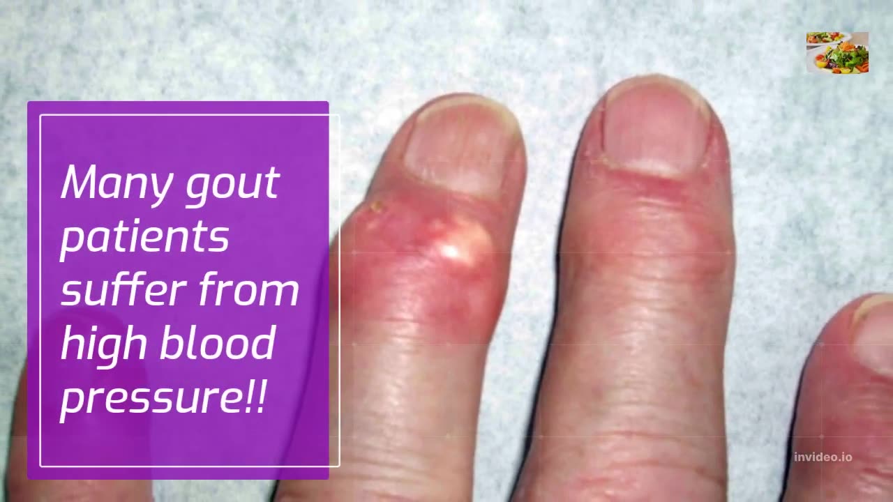 What to Eat and Avoid When You Have Gout