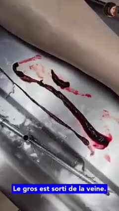 Autopsie piqouzé / ATTENTION IMAGES SENSIBLES