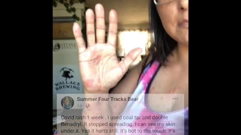 Vaccine injuries part 74