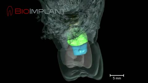 *** µCT OF A ROOT ANALOGUE DENTAL IMPLANT ***