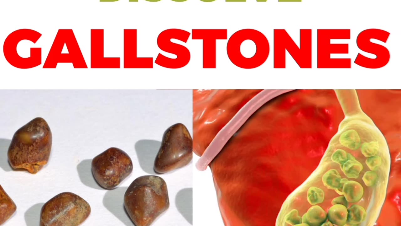 The FASTEST Way To Dissolve Gallstones