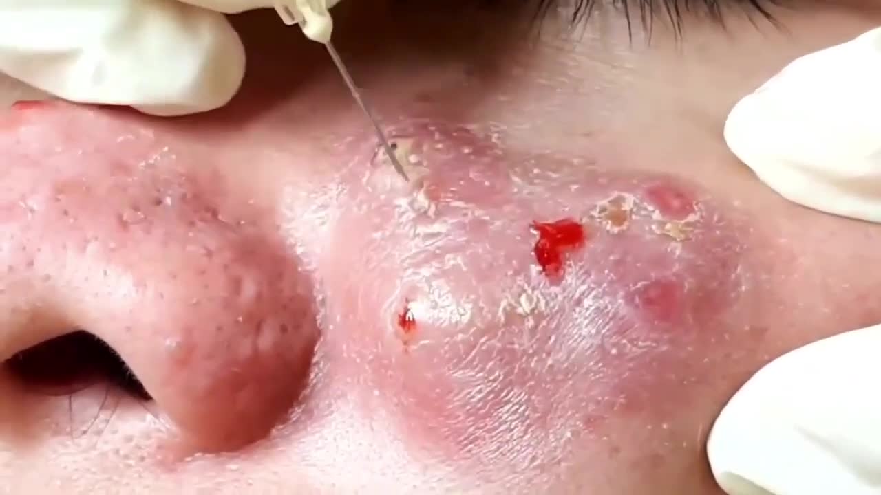 Best Relaxing Acne Removal