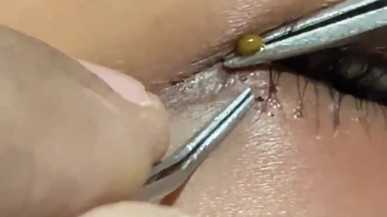 Tick removal