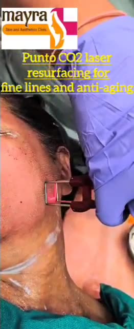 Punto CO2 Laser Resurfacing Treatment