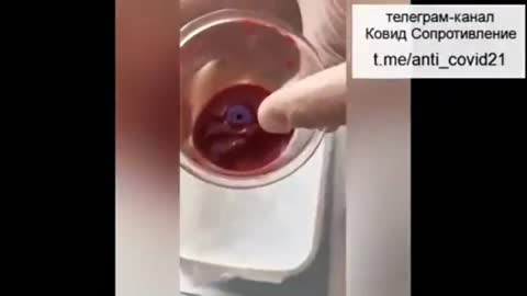 What The Vaccine Does To your Blood - Removed in Real Time