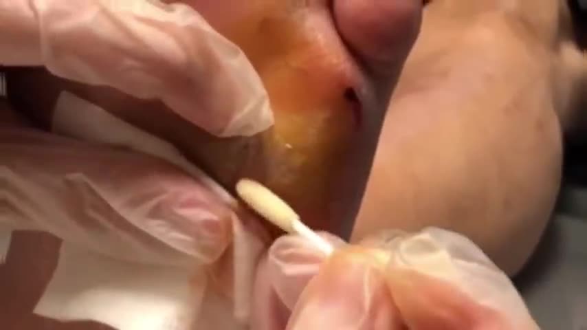 Exploding abscess !!!!