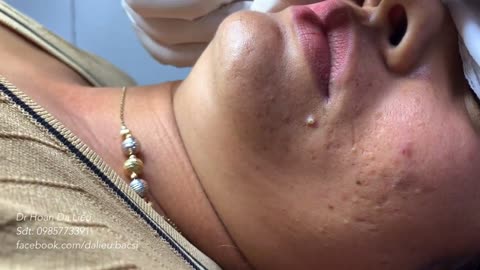 blackhead