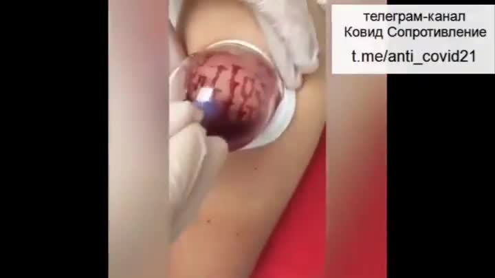 2021_年中_某日，疫苗注射後，採取拔罐吸出血栓……ㄧ